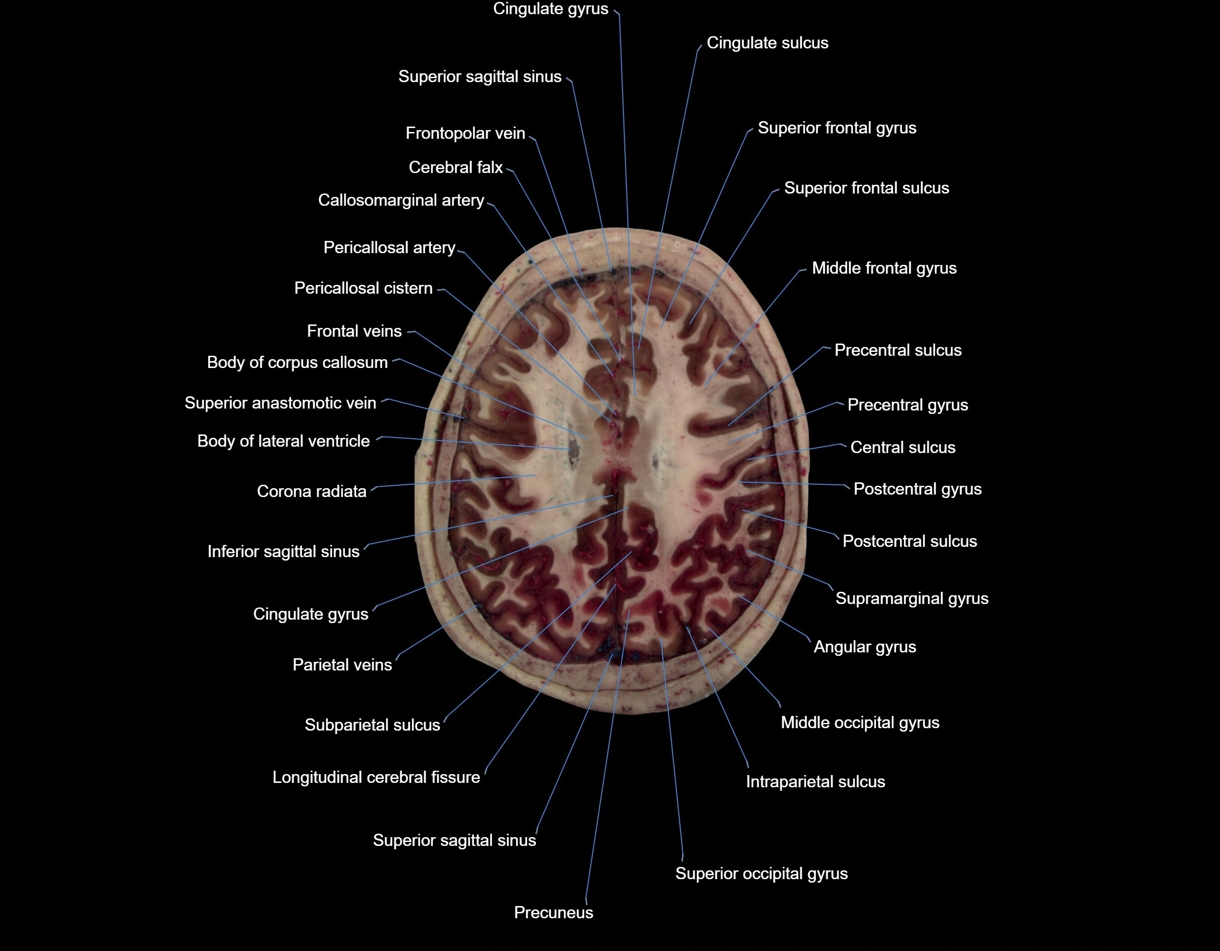 MRI Brain axial cross sectional radiology anatomy 3T image  -img-000056.webp